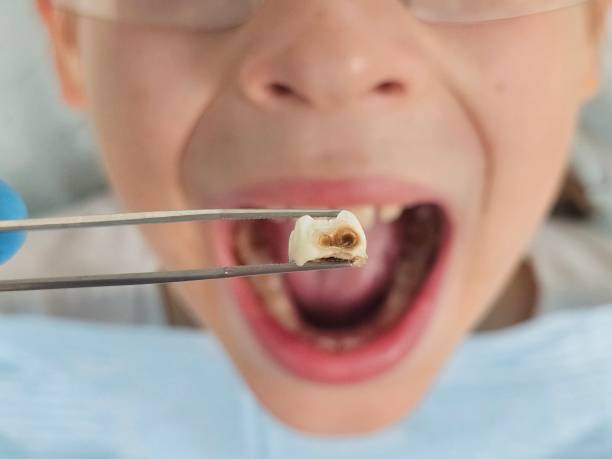 Best Emergency Dental Care for Broken or Chipped Teeth in Waynesville, NC